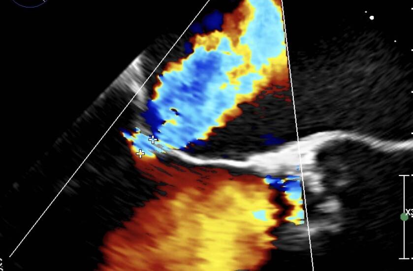 Perstemplinės echokardiografijos tyrimas leidžia pamatyti tikslesnį širdies vaizdą 