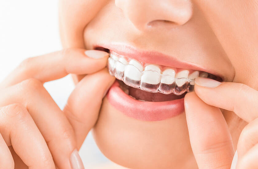 Dantų kapos – patogus ir estetiškas dantų tiesinimo metodas