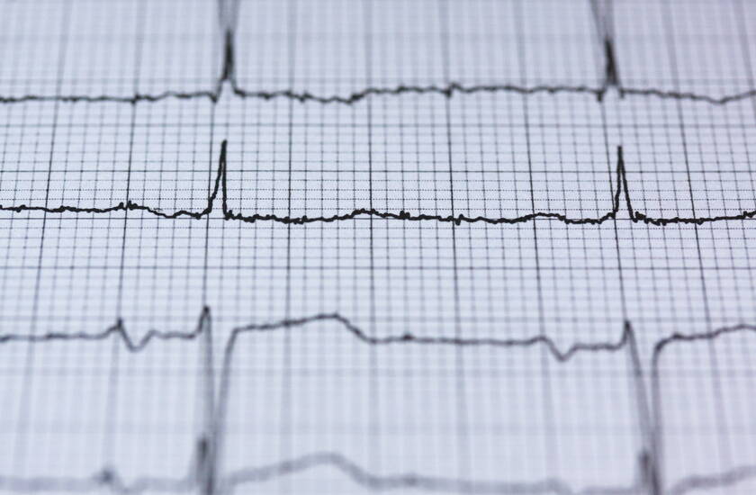 Širdies aritmija: kuo ji pavojinga?